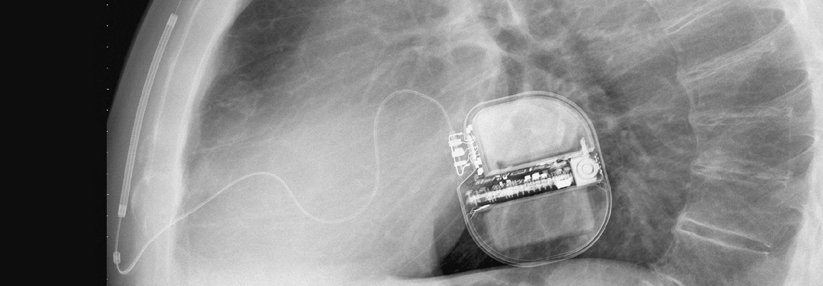 Das Kabel mit den zwei Elektroden und der Defi-Spule verläuft beim subkutanen ICD parallel zum Sternum.