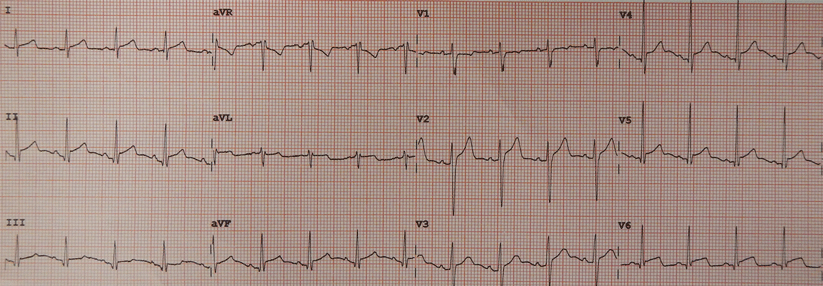 In diesem Perikarditis-EKG sieht man ST-Hebungen über der Vorderwand.