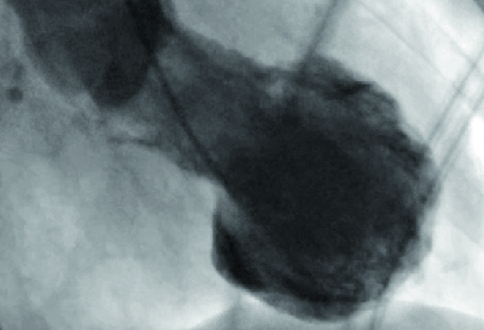 Das Takotsubo-Herz (Ventrikulographie) ähnelt in seiner Form einer Tintenfisch-Falle. © Universitäres Herzzentrum Zürich