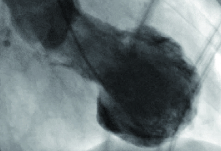 Weltweit größte Studie zur Takotsubo-Kardiomyopathie wurde jetzt veröffentlicht Das Takotsubo-Herz (Ventrikulographie) ähnelt in seiner Form einer Tintenfisch-Falle. © Universitäres Herzzentrum Zürich