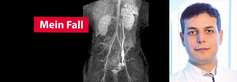  Im Angio-MRT stellt sich zwischen linker Niere und Becken die Vena ovarica kräftig dar, die Varicosis pelvis links lässt sich gut erkennen. 