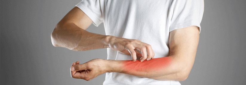 CHMP empfiehlt die Zulassung von Dupilumab Eine atopische Dermatitis kann mit starkem, anhaltendem Juckreiz und trockener Haut, Hautrissen, Hautrötungen, Krustenbildung und nässender Haut einhergehen.