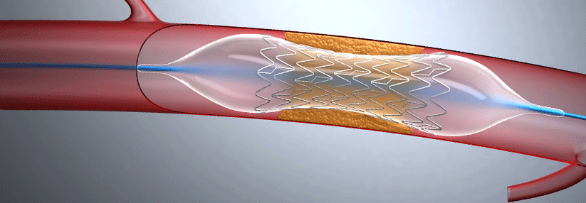 Die OCT lässt sich gut zur Planung der Stentgröße und für die Kontrolle nach dem Eingriff nutzen.