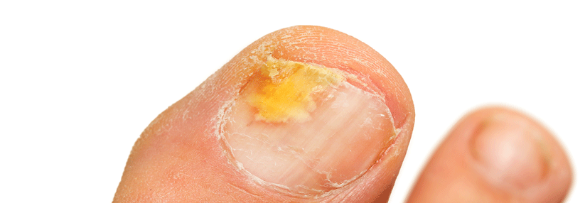 Zeigt her eure Füße Nagelpilz ist bei Diabetes besonders riskant.