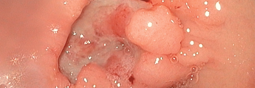 Bei intestinalen Antrum-Karzinomen des Magens ist eine 4/5-Resektion nach Billroth möglich.