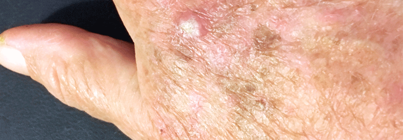 Gut geschmiert: Frühe Wundheilung nach ablativer Lasertherapie mit Salbe fördern Chronische Lichtschädigungen
sollte man per
Laser behandeln.