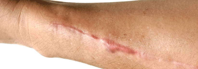 Trio gegen hypertrophe Narben Keloide entstehen durch überschießendes Wachstum von Fibroblasten. Menschen dunkler Hautfarbe sind häufiger betroffen als Hellhäutige.