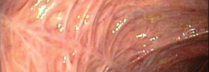 Bei Colitis ulcerosa führt jeder Schub zu einer weiteren Vernarbung des Darmgewebes.