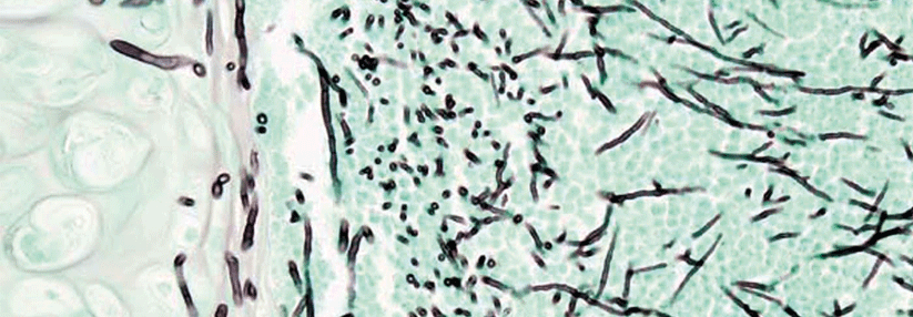 Histologie einer pulmonalen invasiven Aspergillose bei einem Pneumonie-Patienten.
