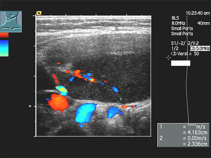 Non Hodgkin Lymphom Medical Tribune