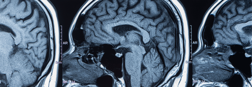 Etwa 2–3 % aller primären intrakraniellen Tumoren sind primäre ZNS-Lymphome.