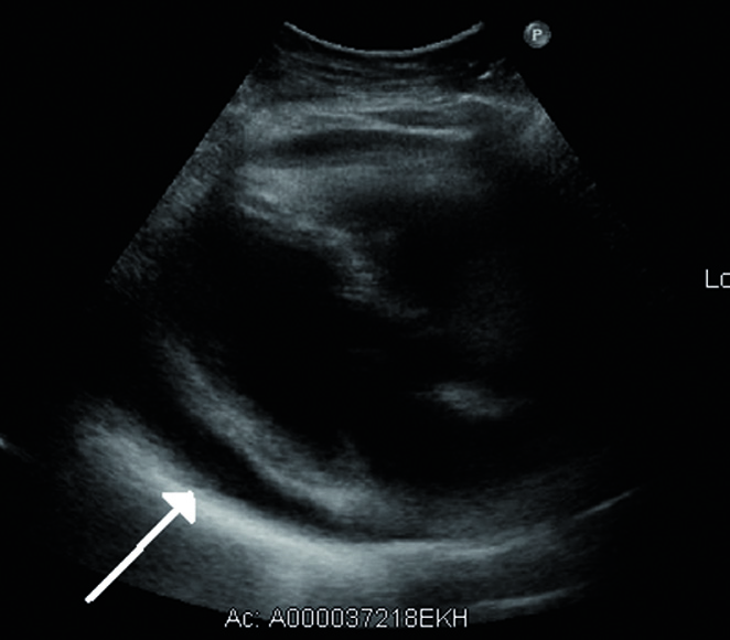 Perikarditis – Neue Leitlinie gibt Ihnen einen klaren Therapie-Plan an die Hand Echokardiographisch lässt sich die Flüssigkeitsansammlung im Herzbeutel sehr deutlich darstellen.
© wikimedia/James Heilmann.