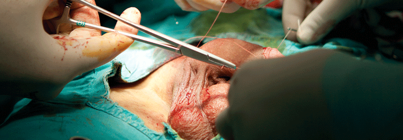 Nach der Transplantation wachsen die Nerven des Empfängers in den Penis des Toten ein.