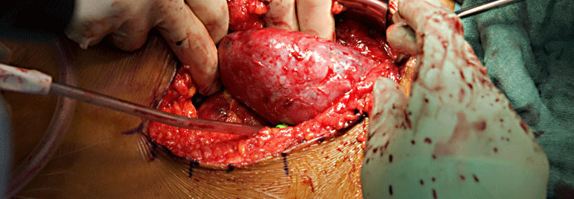 Die Aufnahme in die Warteliste zur Organtransplantation ist Voraussetzung für den Nierenersatz.