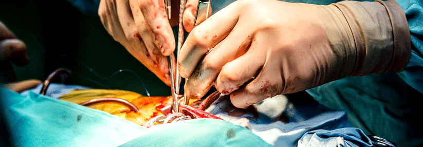 Kasse fordert Mindestmenge für die Aneurysma-Operation der Aorta abdominalis Die Sterblichkeitsrate ist nach drei Jahren in zertifizierten Zentren um zwei Prozentpunkte niedriger.