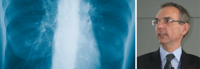 Haben wir in der Vergangenheit COPD falsch therapiert? Prof. Dr. med. Adrian Gillissen, Direktor Medizinische Klinik III, Klinikum am Steinenberg/Ermstalklinik, im Interview.