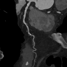 Trotz des Kalks lässt sich diese (Stenose) mit dem modernen CT-Scanner sicher ausschließen, was vor allem die multiplanare Rekonstruktion desselben Gefäßes verdeutlicht.