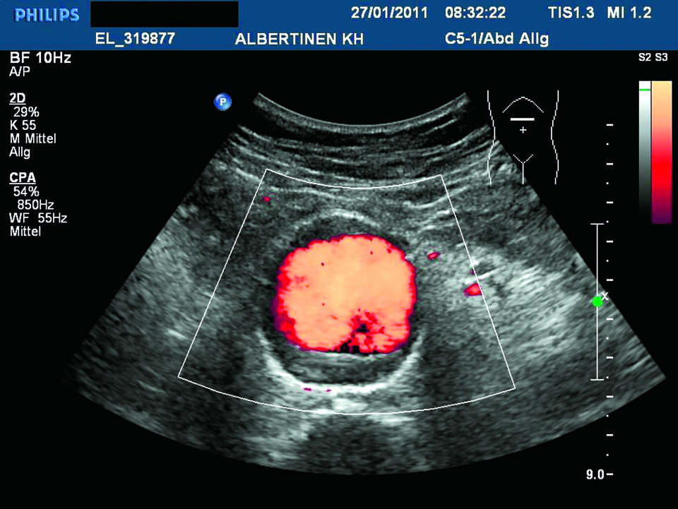 Sonographie eines Bauchaortenaneurysmas