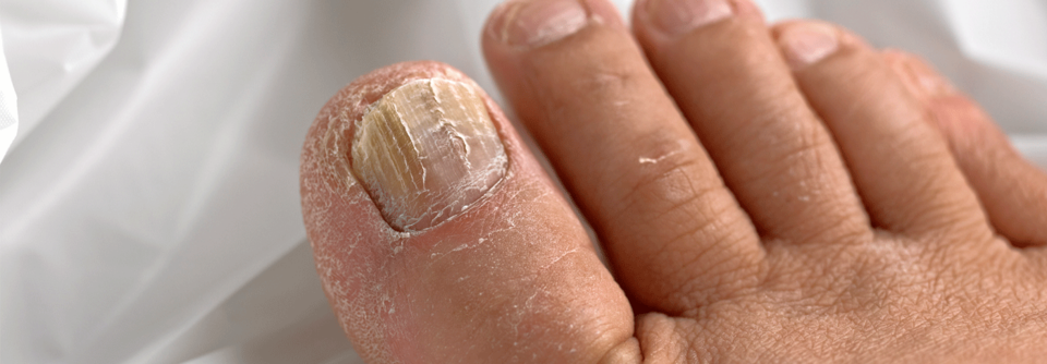 Haben sich auf mehr als der Hälfte eines Nagels oder auf mindestens vier Nägeln Trichophyten breitgemacht, sollte zusätzlich eine systemische Therapie erfolgen.