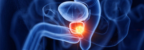 Prostatakarzinom: Neue EBM-Ziffern für Brachytherapie