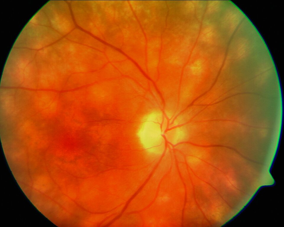 Birdshot-Chorioretinopathie mit den charakteristischen rundlichen, subretinal lokalisierten, cremefarbigen Läsionen des Fundus („White Dots“).