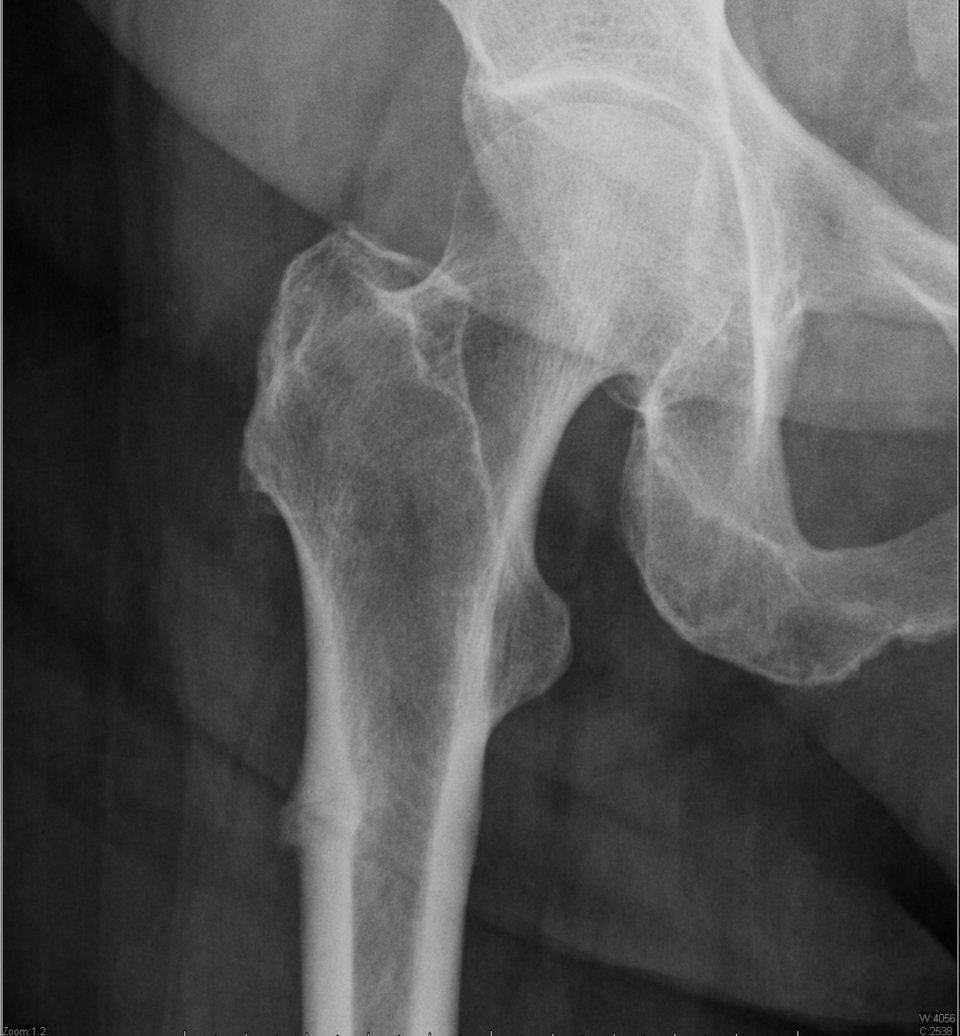 82-jährige Frau mit bisphosphonatbedingter atypischer transversaler Belastungs-insuffizienzfraktur. Der  subtrochantäre Kortex des proximalen Femurs ist verdickt.