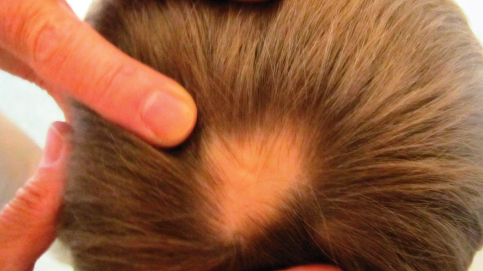 Alopecia areata