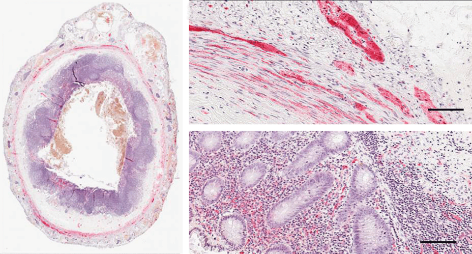 Die histologische Färbung der Appendix eines gesunden Patienten zeigt ein hohes Proteinase-K-resistentes alpha-Synuclein-Vorkommen (rot) im Querschnitt (links), in der Muscularis externa (oben) und der Mucosa (unten). Das Protein findet sich akkumuliert auch in den bei M. Parkinson auftretenden Lewy-Körperchen. Eine Balkenlänge entspricht 100 µm.