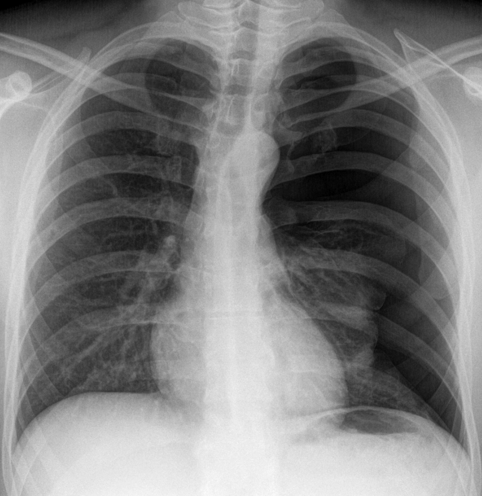 Spontanpneumothorax links (im Bild rechts).