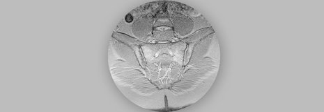 Axiale Spondyloarthritis auch bei fehlenden radiologischen Befunden möglich