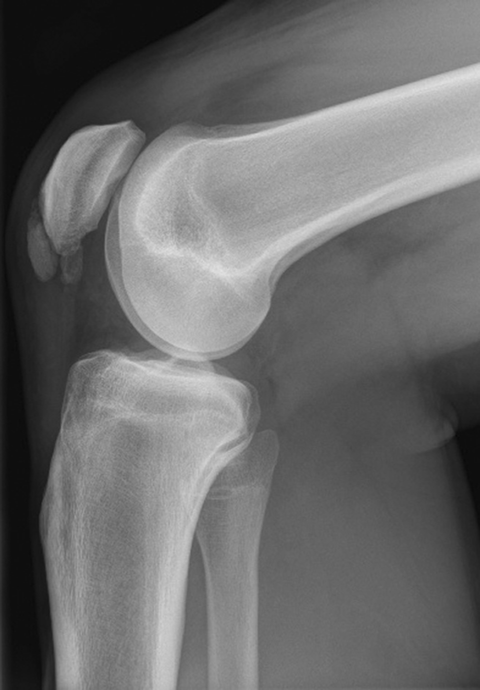 Das Patellaspitzensyndrom (M. Sinding-Larsen-Johansson) ist quasi der weibliche M. Osgood-Schlatter mit einer Osteonekrose der Patellaspitze.