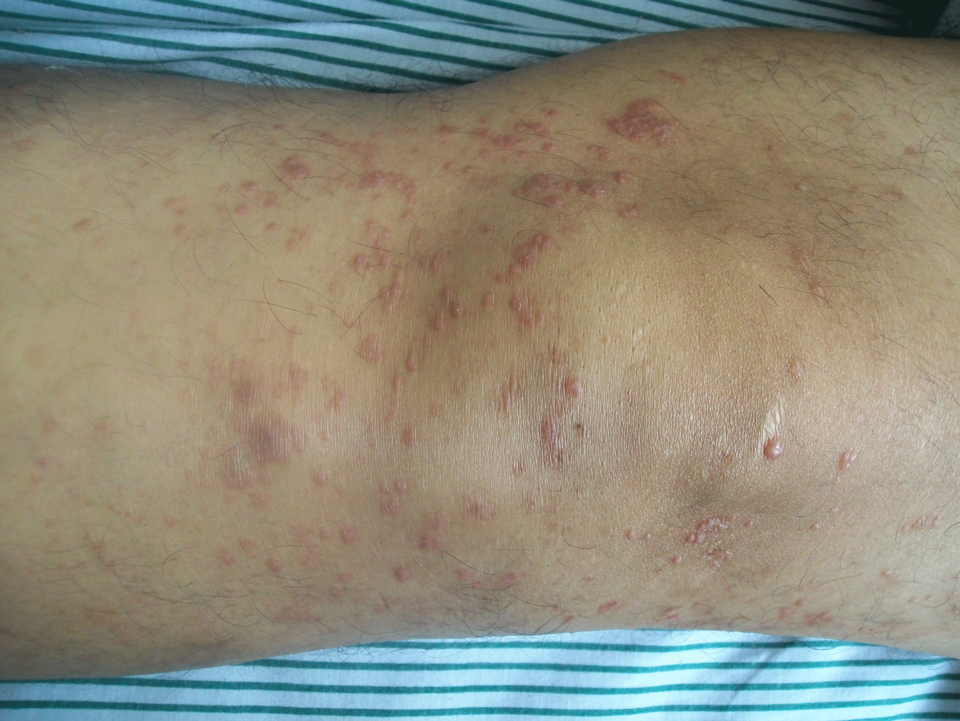 Knie eines männlichen 52-jährigen Patienten mit Hautveränderungen als Merkmal der mycosis fungoides.