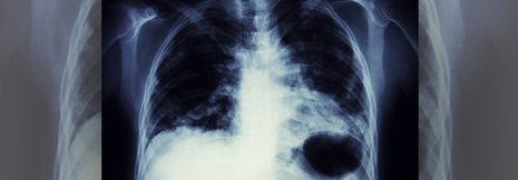 Adjuvante Immuntherapie bei NSCLC erfolgreich – Atezolizumab verlängert PFS nach Tumorresektion