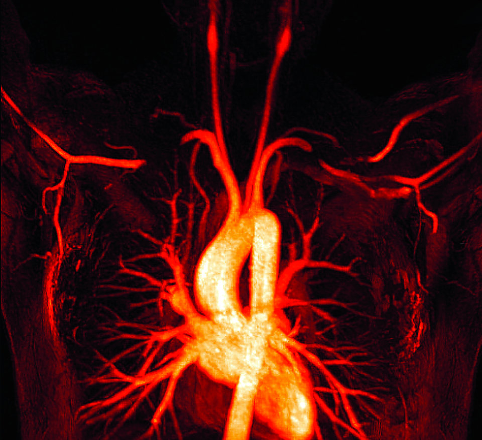 Eine Kompression des Bündels aus Plexus brachialis, A. und V. subclavia macht sich durch Schmerzen und Kribbeln im Arm bemerkbar. Beim Anheben der Arme kann der Blutfluss stark eingeschränkt werden.