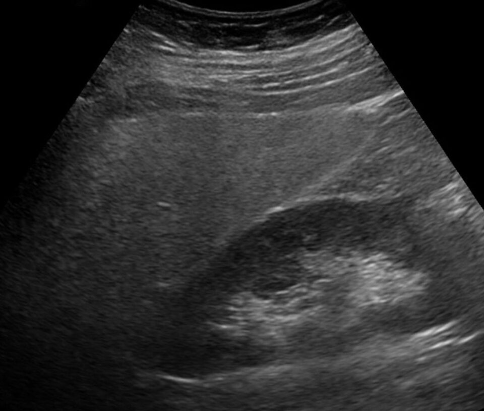 Im Ultraschall lässt sich eine Fettleber an ihrer höheren Echogenität erkennen – oft schon bevor Symptome auftreten.