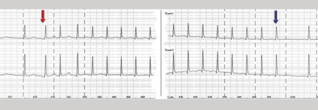 Supraventrikuläre Tachykardien: Medikamentöse Behandlung oder Katheterablation?