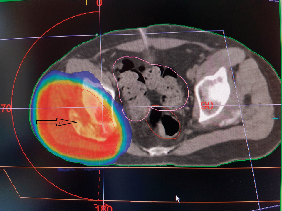 Die volumenmodulierte Strahlentherapie einer heterotropen Ossifikation am rechten Hüftgelenk stellt keine größere Belastung für die Beckenorgane dar.