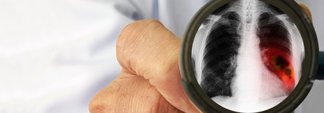 Reserzierbares NSCLC: Nivolumab zusätzlich zur Chemotherapie als sinnvolle Option
