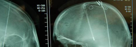 Parkinson: Tiefe Hirnstimulation liefert wichtige Informationen