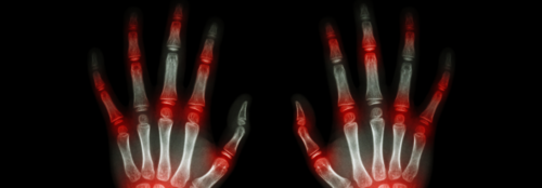 Multiple Sinusitiden verstärken das Risiko