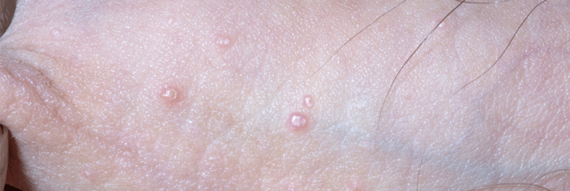 Genitalwarzen auf der Haut