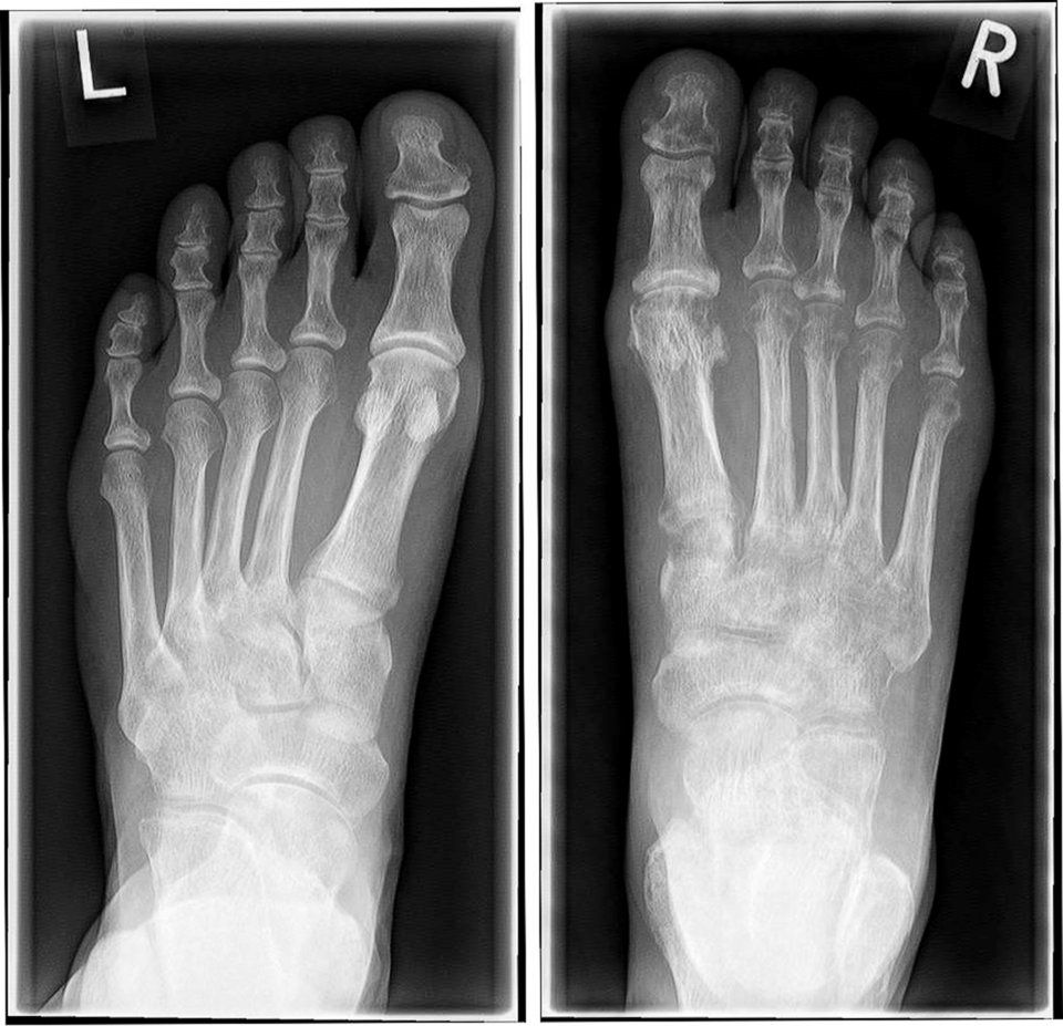 Das Röntgenbild zeigt rechts einen
hochgradig osteoporotischen Knochen, bedingt durch neurogene Entzündung und Immobilisation. Eine aktive Psoriasis-Arthritis ließ sich im MRT ausschließen.