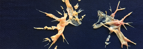 Chronische thromboembolische pulmonale Hypertonie – Diagnose und Behandlung