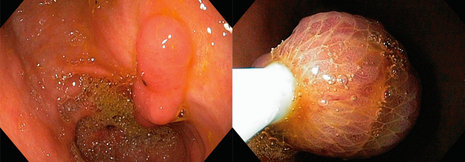 Polypen im oberen Gastrointestinaltrakt: Wann wird operiert?