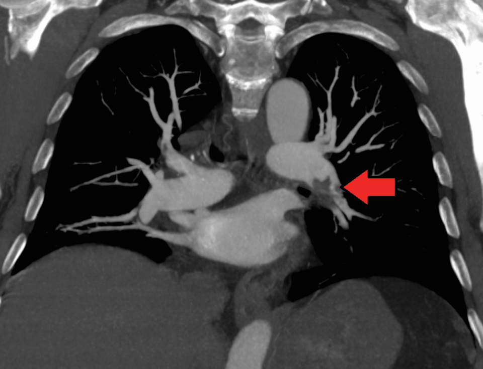 Lungenembolie in der linken Lunge.