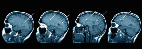 MS-Pathogenese: MRT zeigt inflammatorische und degenerative Prozesse