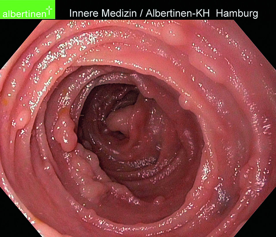Polyposis coli im Sigma.