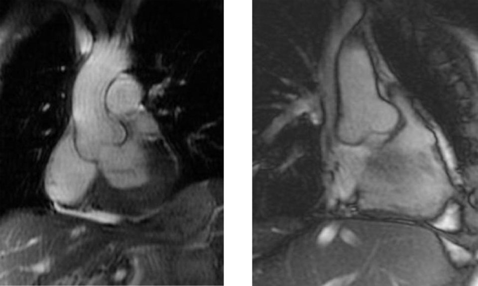 Aortenwurzeldilatation bei einem Patienten mit Morbus Fabry.