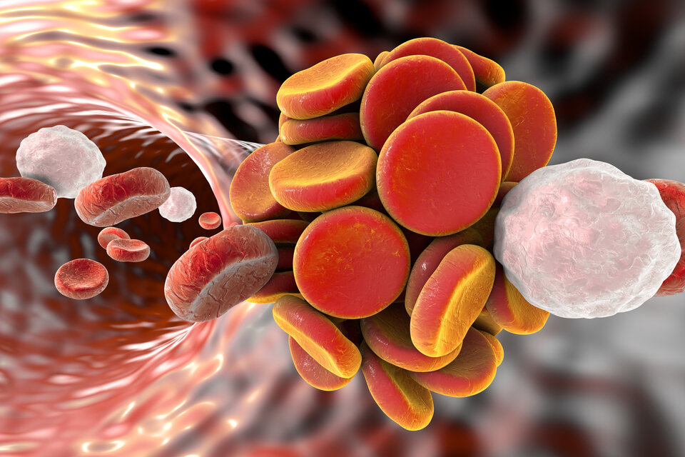 Kopf-Hals-Tumoren: VTE-Prophylaxe sinnvoll?