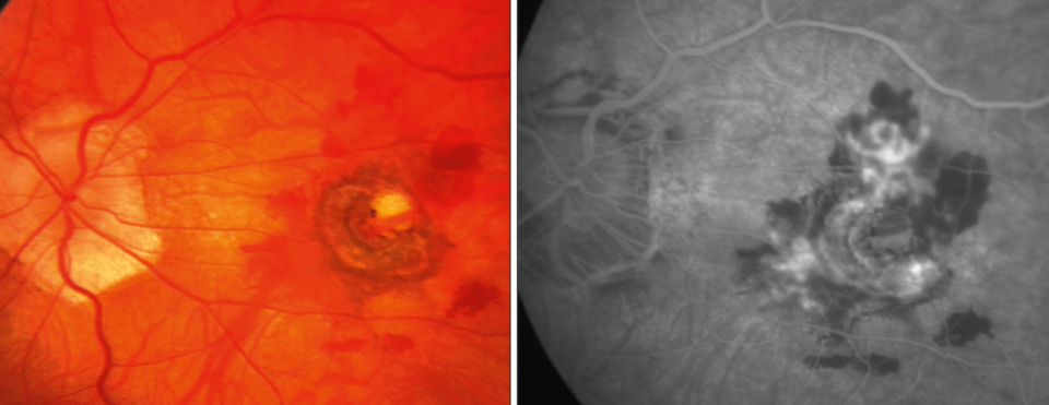 Abb. 2: Gefäßneubildung im Bereich der Makula bei einem Patienten mit krankhafter Kurzsichtigkeit – Augenhintergrund (links) und Fluoreszenzangiographie (rechts).